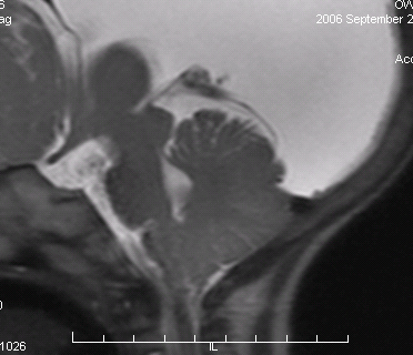 Chiari-Plain.jpg