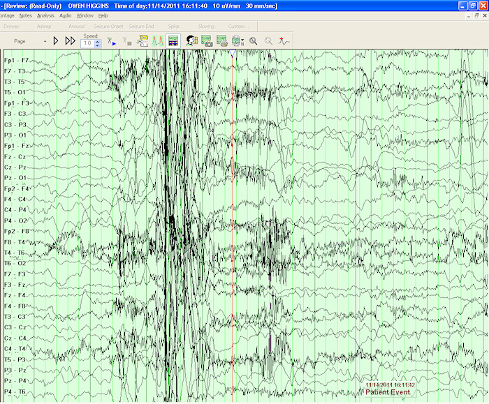 absence seizure without eeg changes