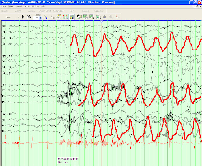 eeg-seizure-highlighted.jpg